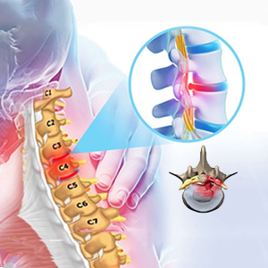 Thoái hóa đốt sống cổ